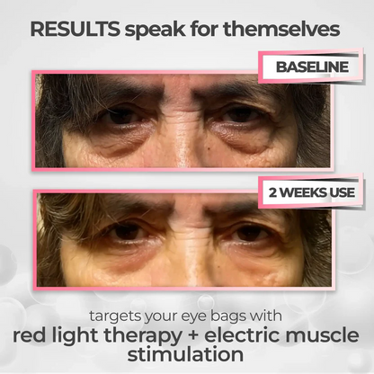 EyeLift Pro™ 2-in-1 Red Light Therapy + EMS Eye Rejuvenator