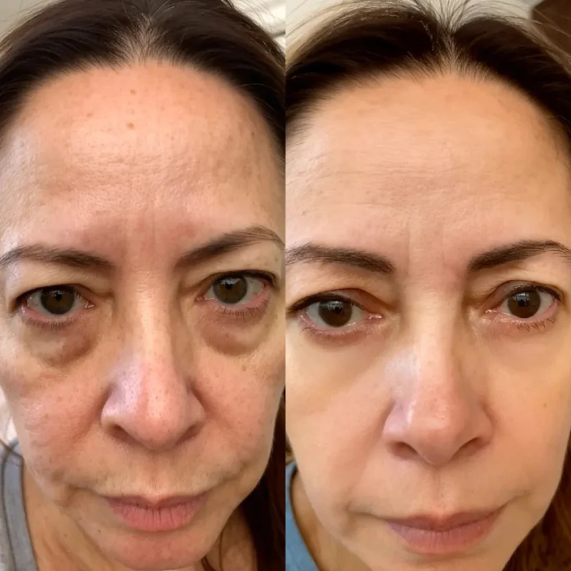 EyeLift Pro™ 2-in-1 Red Light Therapy + EMS Eye Rejuvenator